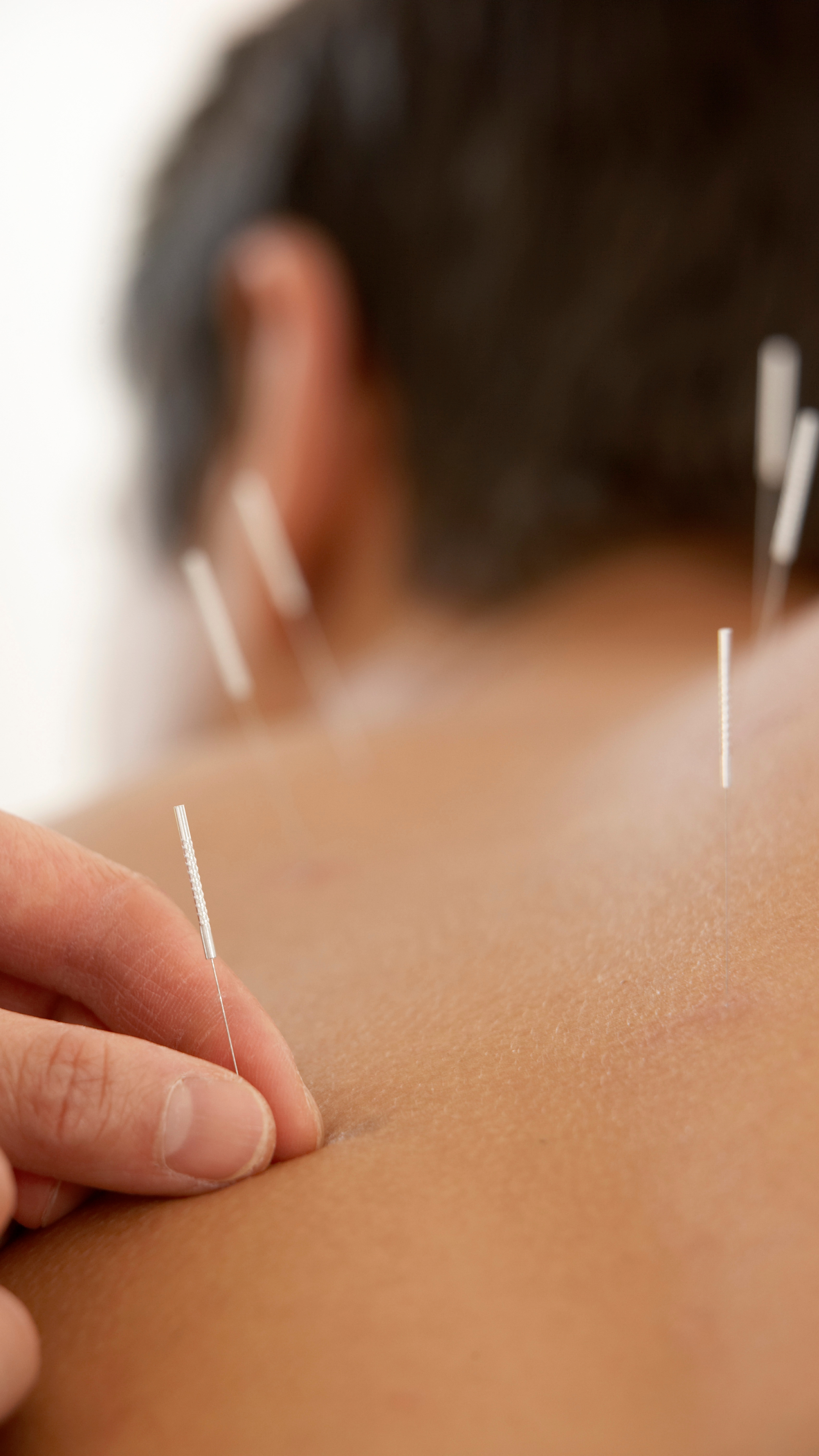 Acupuncture